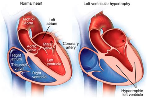 heart lv|living with left ventricular hypertrophy.